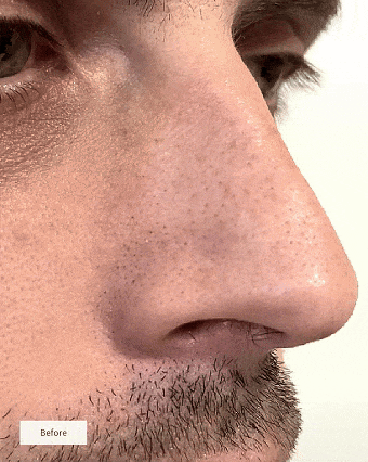 Hydrogel Nose Patches