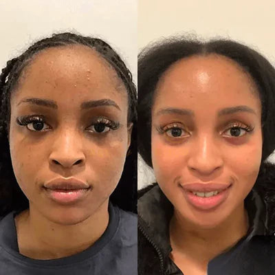 Clearer Skin. More Confidence Daily.